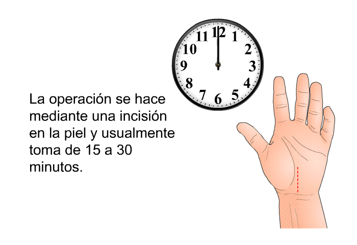 La operacin se hace mediante una incisin en la piel y usualmente toma de 15 a 30 minutos.