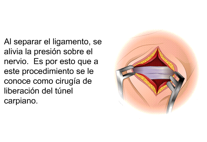 Al separar el ligamento, se alivia la presin sobre el nervio. Es por esto que a este procedimiento se le conoce como ciruga de liberacin del tnel carpiano.