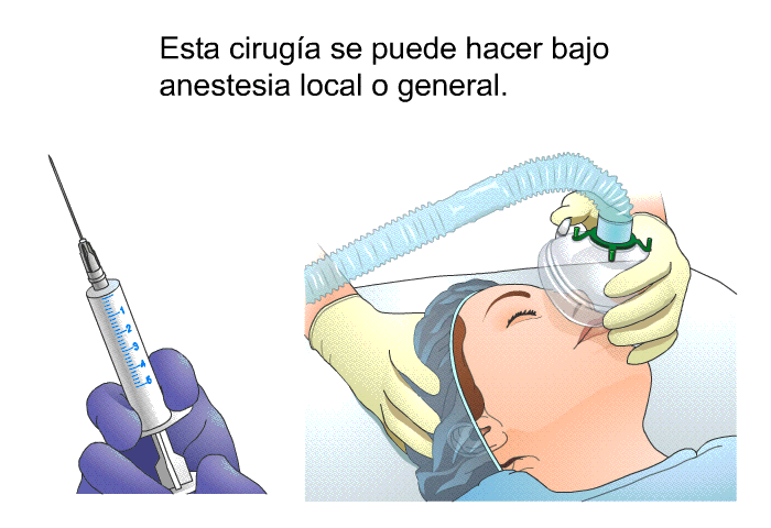 Esta ciruga se puede hacer bajo anestesia local o general.