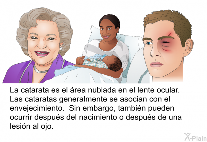 La catarata es el rea nublada en el lente ocular. Las cataratas generalmente se asocian con el envejecimiento. Sin embargo, tambin pueden ocurrir despus del nacimiento o despus de una lesin al ojo.