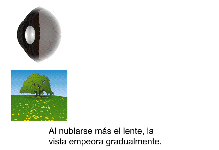 Al nublarse m�s el lente, la vista empeora gradualmente.