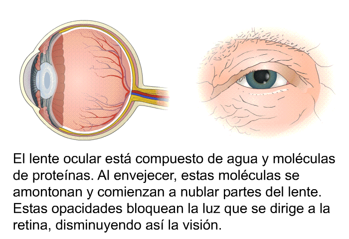 El lente ocular est compuesto de agua y molculas de protenas. Al envejecer, estas molculas se amontonan y comienzan a nublar partes del lente. Estas opacidades bloquean la luz que se dirige a la retina, disminuyendo as la visin.