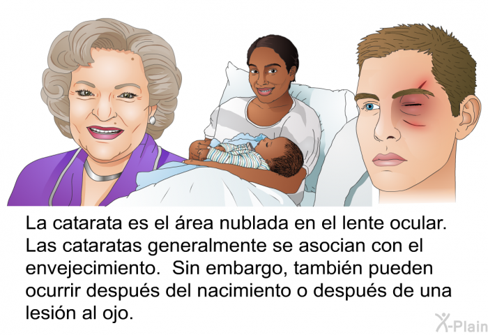 La catarata es el rea nublada en el lente ocular. Las cataratas generalmente se asocian con el envejecimiento. Sin embargo, tambin pueden ocurrir despus del nacimiento o despus de una lesin al ojo.