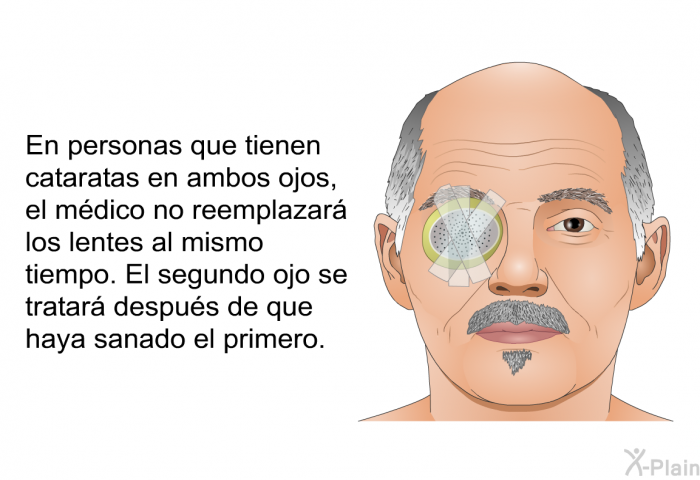 En personas que tienen cataratas en ambos ojos, el m�dico no reemplazar� los lentes al mismo tiempo. El segundo ojo se tratar� despu�s de que haya sanado el primero.