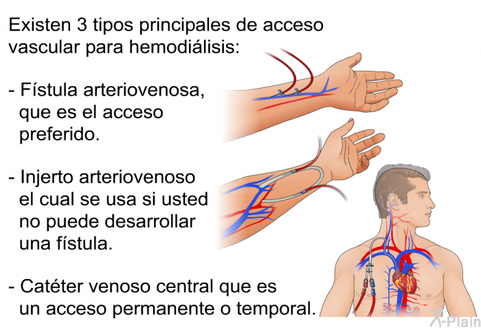 Existen 3 tipos principales de acceso vascular para hemodilisis:  Fstula arteriovenosa, que es el acceso preferido. Injerto arteriovenoso el cual se usa si usted no puede desarrollar una fstula. Catter venoso central que es un acceso permanente o temporal.