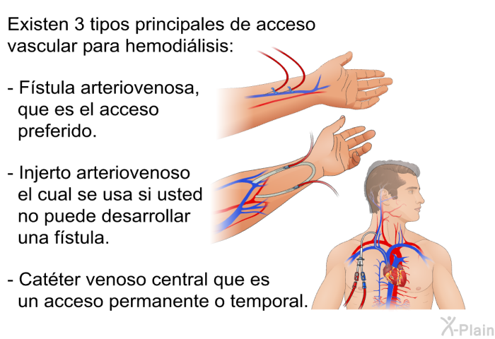 Existen 3 tipos principales de acceso vascular para hemodilisis:  Fstula arteriovenosa, que es el acceso preferido. Injerto arteriovenoso el cual se usa si usted no puede desarrollar una fstula. Catter venoso central que es un acceso permanente o temporal.