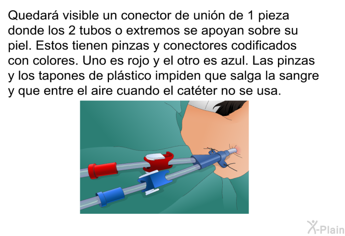 Quedar visible un conector de unin de 1 pieza donde los 2 tubos o extremos se apoyan sobre su piel. Estos tienen pinzas y conectores codificados con colores. Uno es rojo y el otro es azul. Las pinzas y los tapones de plstico impiden que salga la sangre y que entre el aire cuando el catter no se usa.