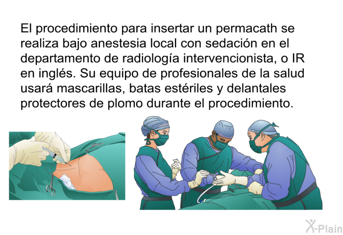 El procedimiento para insertar un <I>permacath</I> se realiza bajo anestesia local con sedacin en el departamento de radiologa intervencionista, o IR en ingls. Su equipo de profesionales de la salud usar mascarillas, batas estriles y delantales protectores de plomo durante el procedimiento.