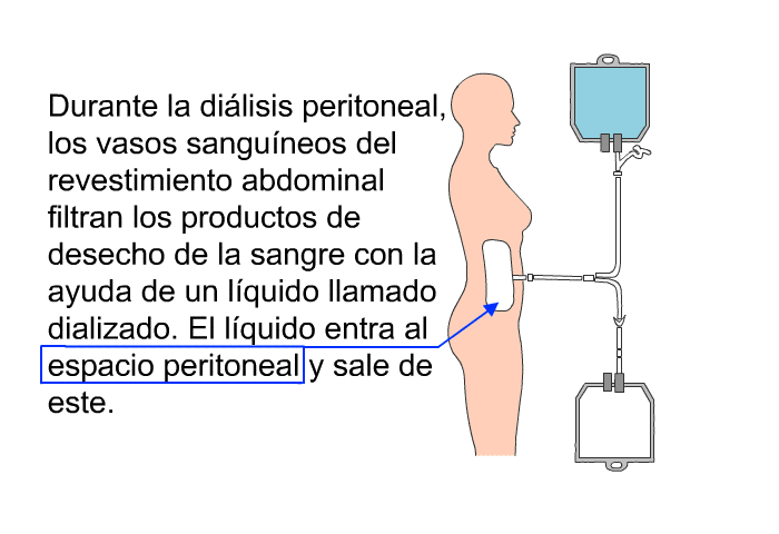 Durante la dilisis peritoneal, los vasos sanguneos del revestimiento abdominal filtran los productos de desecho de la sangre con la ayuda de un lquido llamado dializado. El lquido entra al espacio peritoneal y sale de este.
