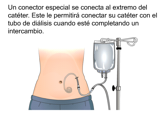 Un conector especial se conecta al extremo del catter. Este le permitir conectar su catter con el tubo de dilisis cuando est completando un intercambio.