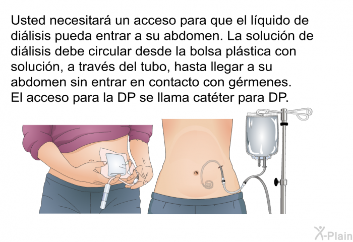 Usted necesitar un acceso para que el lquido de dilisis pueda entrar a su abdomen. La solucin de dilisis debe circular desde la bolsa plstica con solucin, a travs del tubo, hasta llegar a su abdomen sin entrar en contacto con grmenes. El acceso para la DP se llama catter para DP.