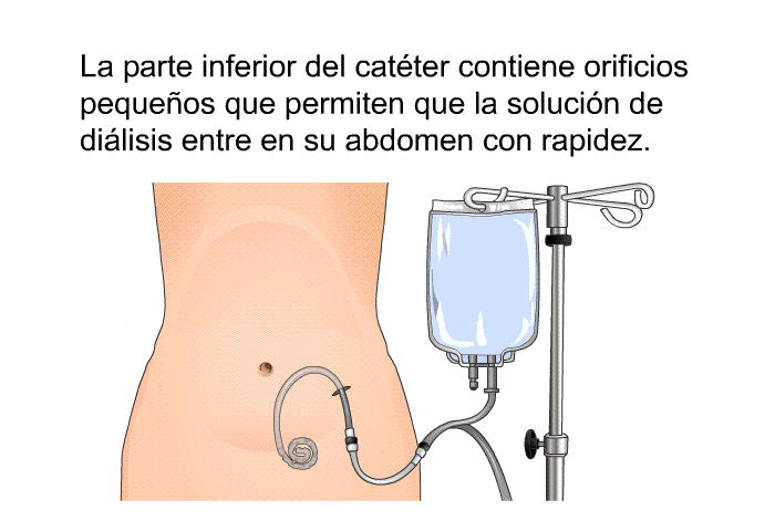 La parte inferior del catter contiene orificios pequeos que permiten que la solucin de dilisis entre en su abdomen con rapidez.