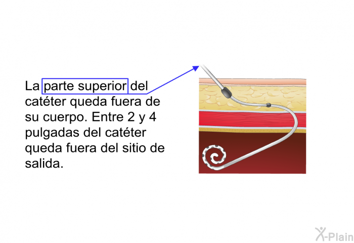 La parte superior del catter queda fuera de su cuerpo. Entre 2 y 4 pulgadas del catter queda fuera del sitio de salida.