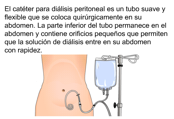 El cat�ter para di�lisis peritoneal es un tubo suave y flexible que se coloca quir�rgicamente en su abdomen. La parte inferior del tubo permanece en el abdomen y contiene orificios peque�os que permiten que la soluci�n de di�lisis entre en su abdomen con rapidez.