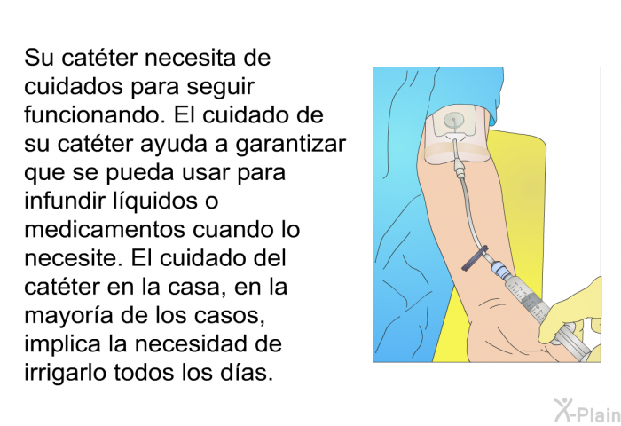 Su catter necesita de cuidados para seguir funcionando. El cuidado de su catter ayuda a garantizar que se pueda usar para infundir lquidos o medicamentos cuando lo necesite. El cuidado del catter en la casa, en la mayora de los casos, implica la necesidad de irrigarlo todos los das.