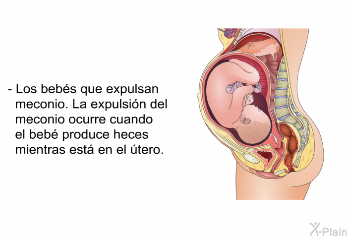 Los bebs que expulsan meconio. La expulsin del meconio ocurre cuando el beb produce heces mientras est en el tero.