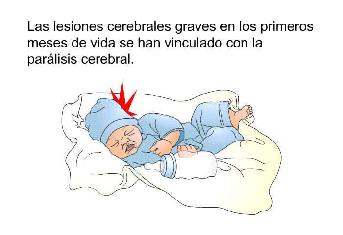 Las lesiones cerebrales graves en los primeros meses de vida se han vinculado con la parlisis cerebral.