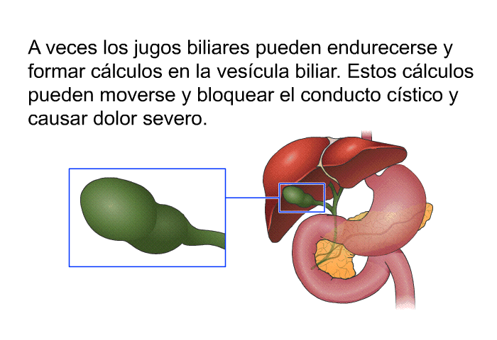 A veces los jugos biliares pueden endurecerse y formar clculos en la vescula biliar. Estos clculos pueden moverse y bloquear el conducto cstico y causar dolor severo.