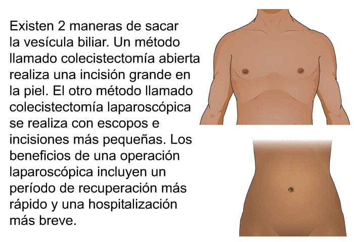 Existen 2 maneras de sacar la vescula biliar. Un mtodo llamado colecistectoma abierta realiza una incisin grande en la piel. El otro mtodo llamado colecistectoma laparoscpica se realiza con escopos e incisiones ms pequeas. Los beneficios de una operacin laparoscpica incluyen un perodo de recuperacin ms rpido y una hospitalizacin ms breve.
