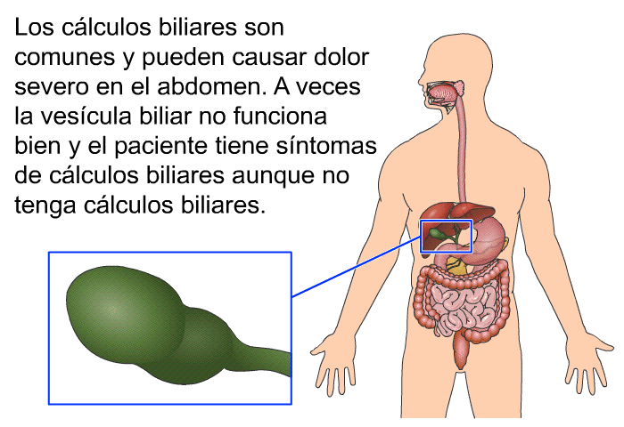 Los clculos biliares son comunes y pueden causar dolor severo en el abdomen. A veces la vescula biliar no funciona bien y el paciente tiene sntomas de clculos biliares aunque no tenga clculos biliares.