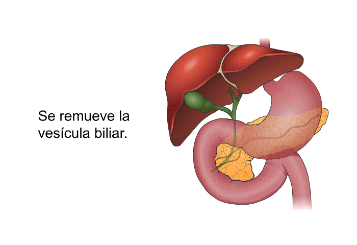 Se remueve la vescula biliar.