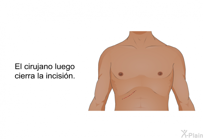 El cirujano luego cierra la incisin.