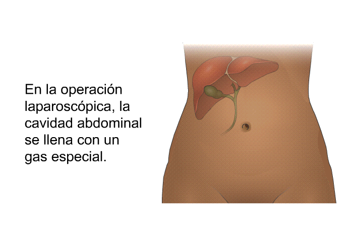 En la operacin laparoscpica, la cavidad abdominal se llena con un gas especial.