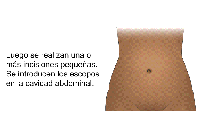 Luego se realizan una o ms incisiones pequeas. Se introducen los escopos en la cavidad abdominal.