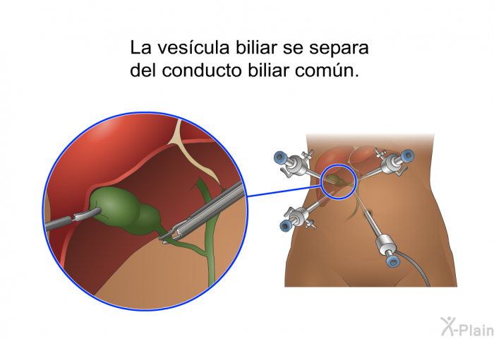 La vescula biliar se separa del conducto biliar comn.