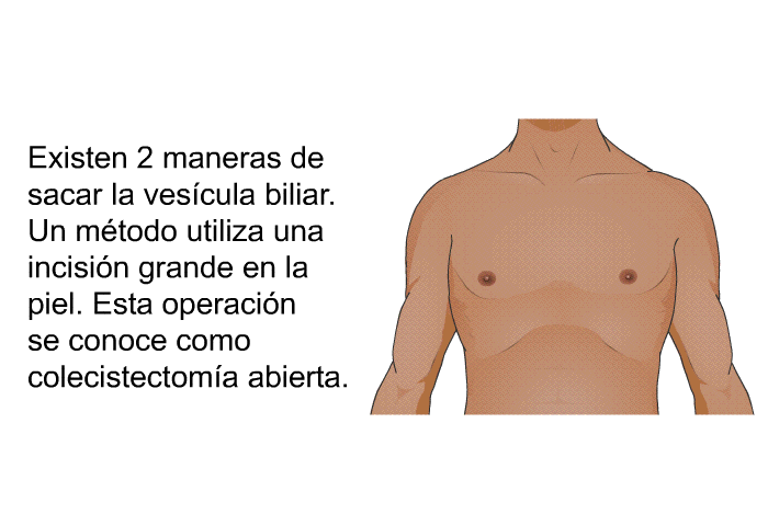 Existen 2 maneras de sacar la vescula biliar. Un mtodo utiliza una incisin grande en la piel. Esta operacin se conoce como colecistectoma abierta.