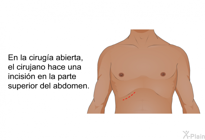 En la ciruga abierta, el cirujano hace una incisin en la parte superior del abdomen.