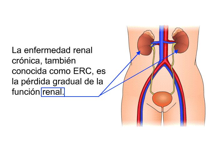 La enfermedad renal crnica, tambin conocida como ERC, es la prdida gradual de la funcin renal.