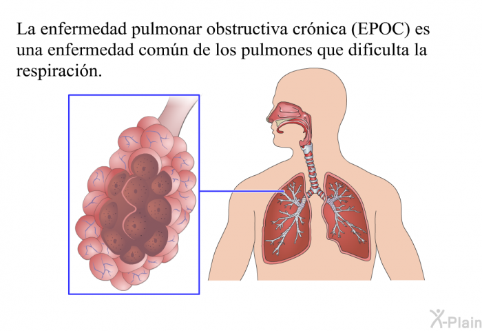 La enfermedad pulmonar obstructiva crnica (EPOC) es una enfermedad comn de los pulmones que dificulta la respiracin.