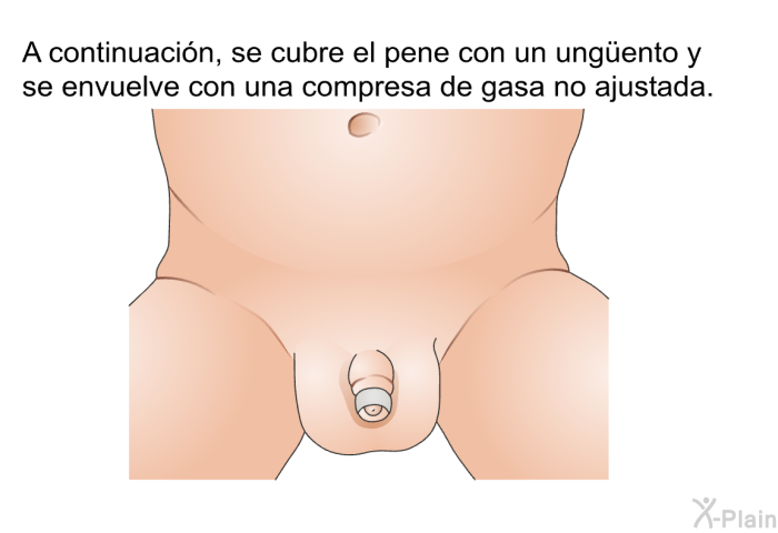 A continuacin, se cubre el pene con un ungüento y se envuelve con una compresa de gasa no ajustada.