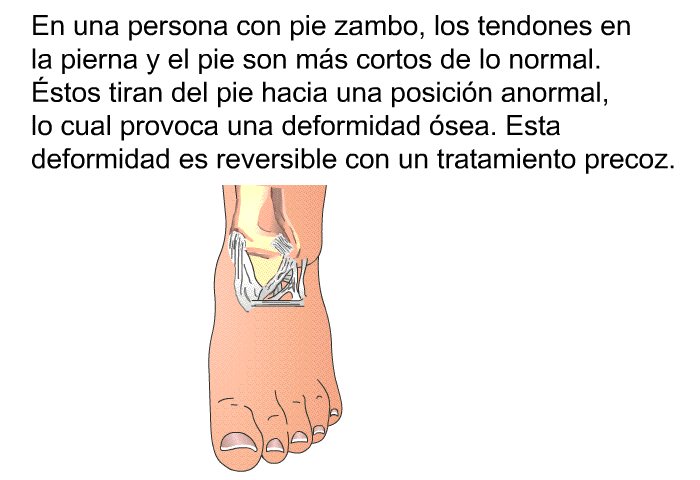 En una persona con pie zambo, los tendones en la pierna y el pie son ms cortos de lo normal. Éstos tiran del pie hacia una posicin anormal, lo cual provoca una deformidad sea. Esta deformidad es reversible con un tratamiento precoz.