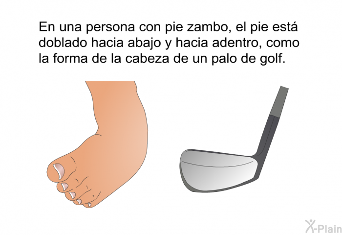 En una persona con pie zambo, el pie est doblado hacia abajo y hacia adentro, como la forma de la cabeza de un palo de golf.