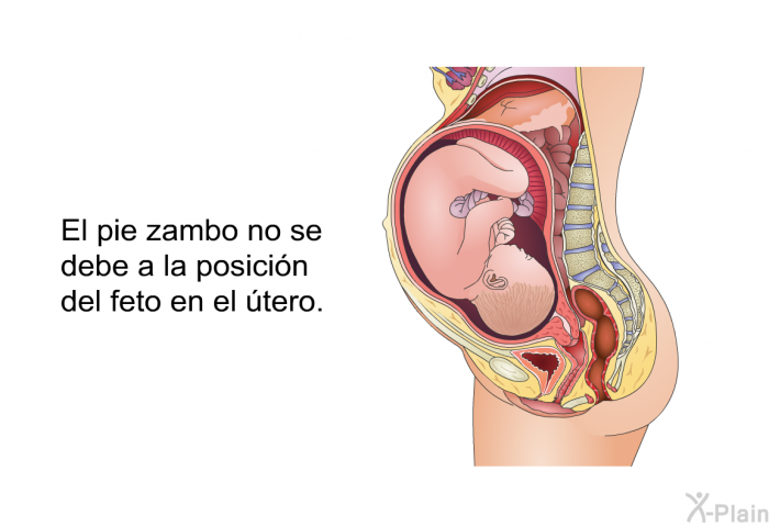 El pie zambo no se debe a la posicin del feto en el tero.
