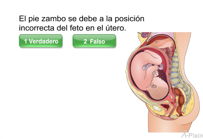 El pie zambo se debe a la posicin incorrecta del feto en el tero.