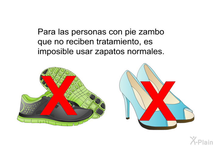 Para las personas con pie zambo que no reciben tratamiento, es imposible usar zapatos normales.