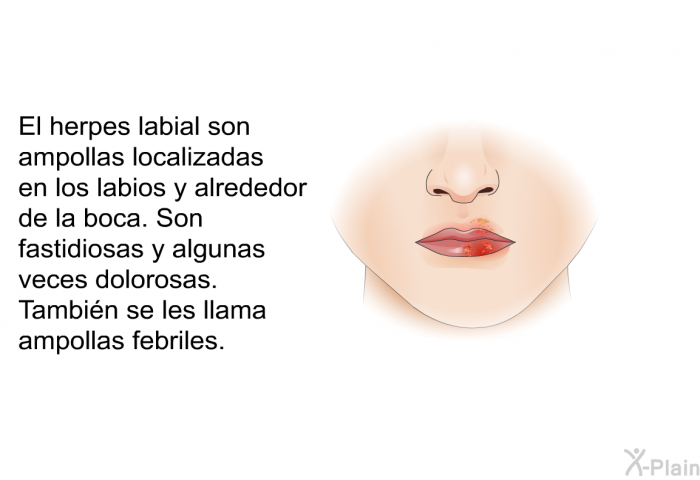 El herpes labial son ampollas localizadas en los labios y alrededor de la boca. Son fastidiosas y algunas veces dolorosas. Tambin se les llama ampollas febriles.