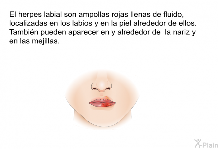 El herpes labial son ampollas rojas llenas de fluido, localizadas en los labios y en la piel alrededor de ellos. Tambin pueden aparecer en y alrededor de la nariz y en las mejillas.