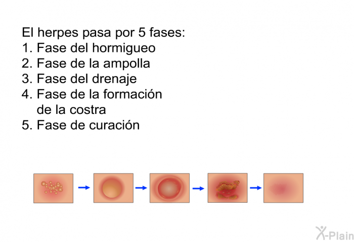 El herpes pasa por 5 fases:  Fase del hormigueo  2. Fase de la ampolla 3. Fase del drenaje  Fase de la formacin de la costar Fase de curacin