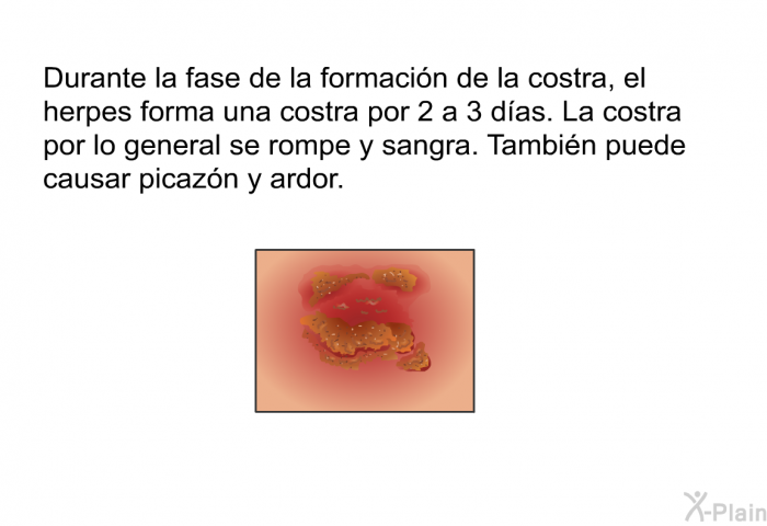 Durante la fase de la formacin de la costra, el herpes forma una costra por 2 a 3 das. La costra por lo general se rompe y sangra. Tambin puede causar picazn y ardor.