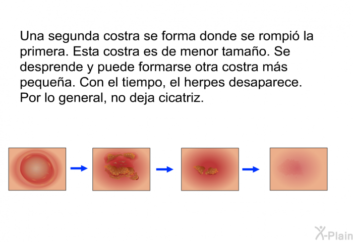 Una segunda costra se forma donde se rompi la primera. Esta costra es de menor tamao. Se desprende y puede formarse otra costra ms pequea. Con el tiempo, el herpes desaparece. Por lo general, no deja cicatriz.