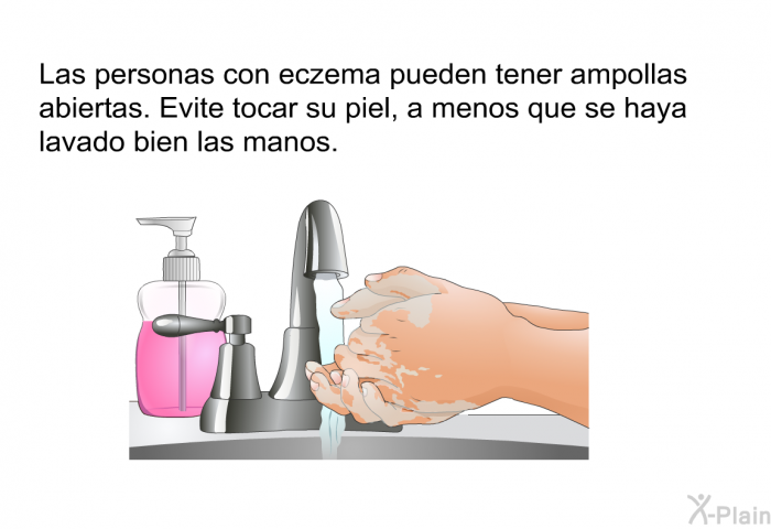 Las personas con eczema pueden tener ampollas abiertas. Evite tocar su piel, a menos que se haya lavado bien las manos.