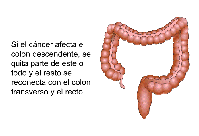 Si el cncer afecta el colon descendente, se quita parte de este o todo y el resto se reconecta con el colon transverso y el recto.