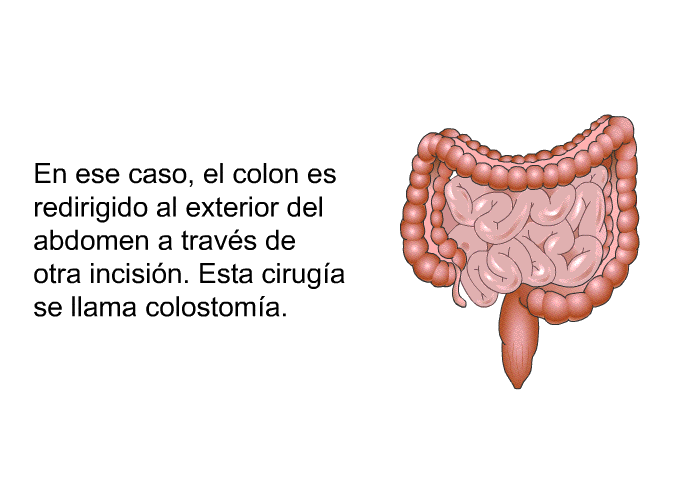 En ese caso, el colon es redirigido al exterior del abdomen a travs de otra incisin. Esta ciruga se llama colostoma.