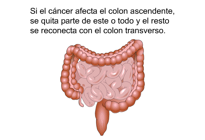 Si el cncer afecta el colon ascendente, se quita parte de este o todo y el resto se reconecta con el colon transverso.