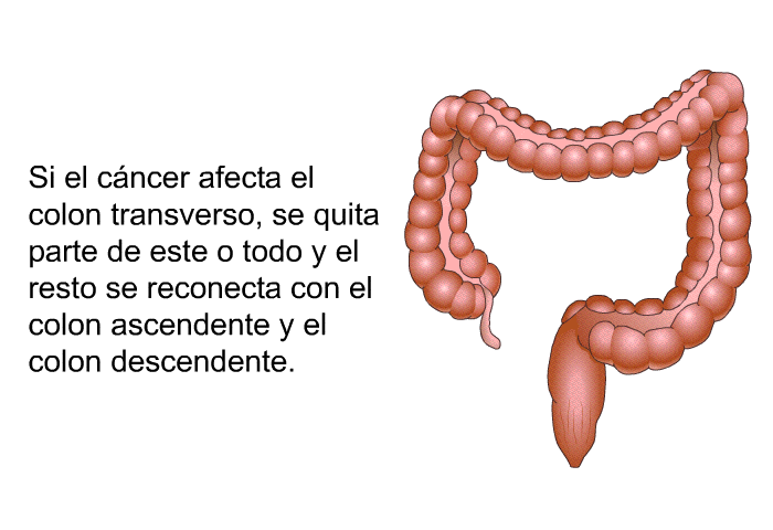 Si el cncer afecta el colon transverso, se quita parte de este o todo y el resto se reconecta con el colon ascendente y el colon descendente.