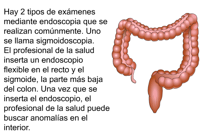 Hay 2 tipos de ex�menes mediante endoscopia que se realizan com�nmente. Uno se llama <I>sigmoidoscopia</I>. El profesional de la salud inserta un endoscopio flexible en el recto y el sigmoide, la parte m�s baja del colon. Una vez que se inserta el endoscopio, el profesional de la salud puede buscar anomal�as en el interior.
